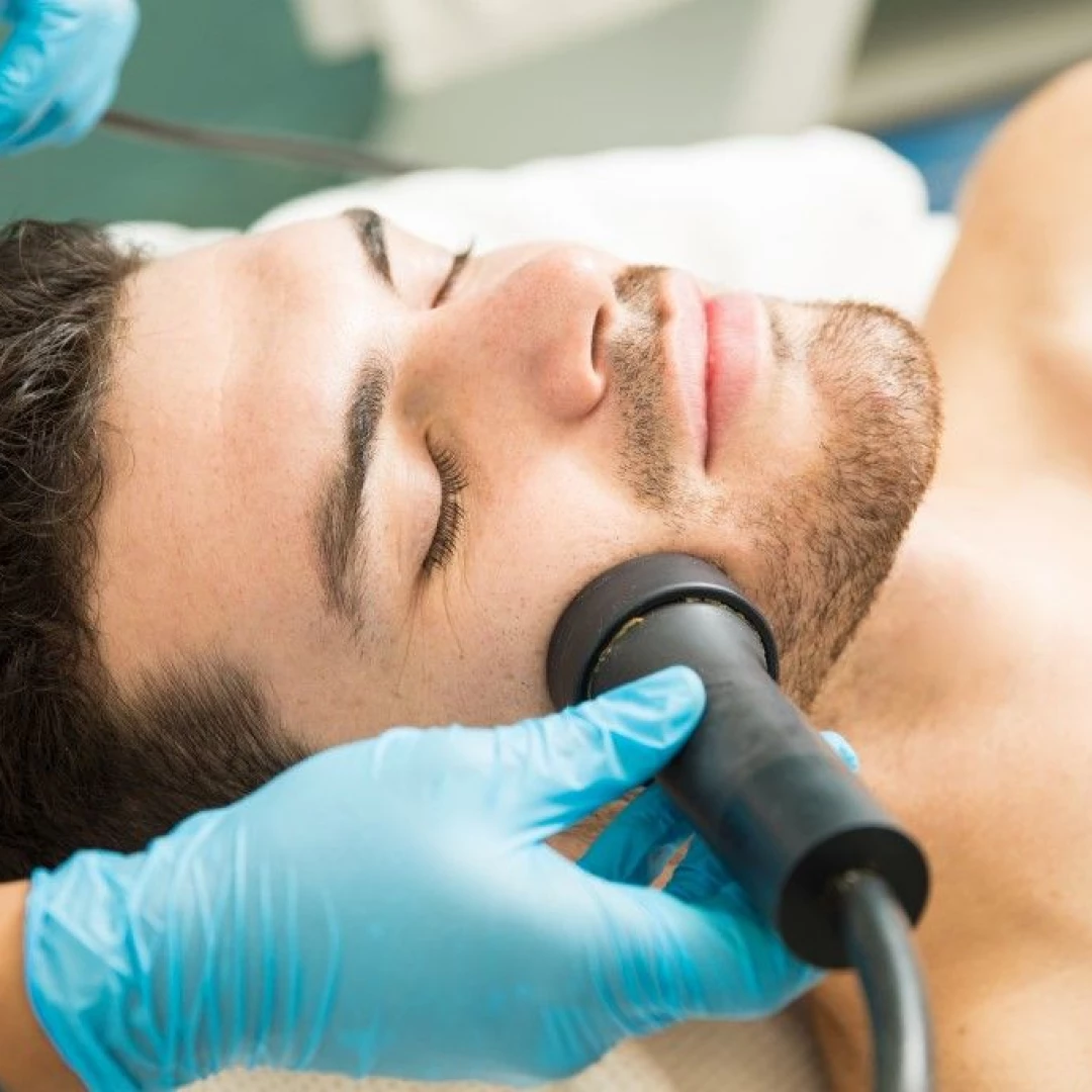 Depilación barbilla